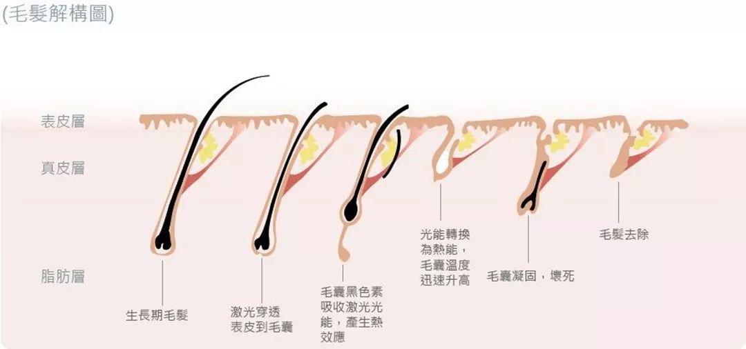 “白煮蛋”與“獼猴桃”之間，還差一個(gè)它 強(qiáng)脈沖脫毛器械，值得買嗎？